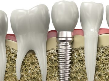 Exames importantes para realizar um implante dentário