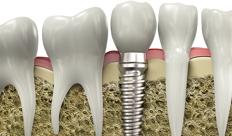 implante dentário